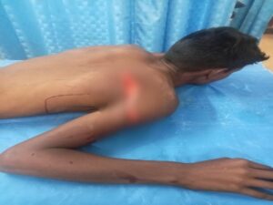 भिलाई के स्कूल मं छात्र ह अपन क्लासमेट ला कटर ले मारिस, 28 टांका लगिस परिजन स्कूल पहुंचके मचाइन हंगामा