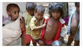 रायपुर जिला के आंगनबाड़ी मन मा अबो घलोक हजारन लइका कुपोषित, तिल्दा अउ अभनपुर मा स्थिति जादा खराब